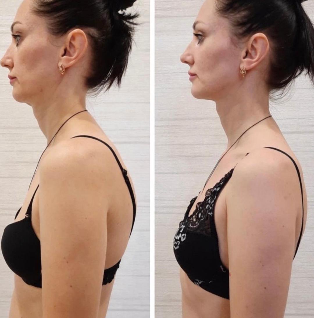 Straighter everyday posture